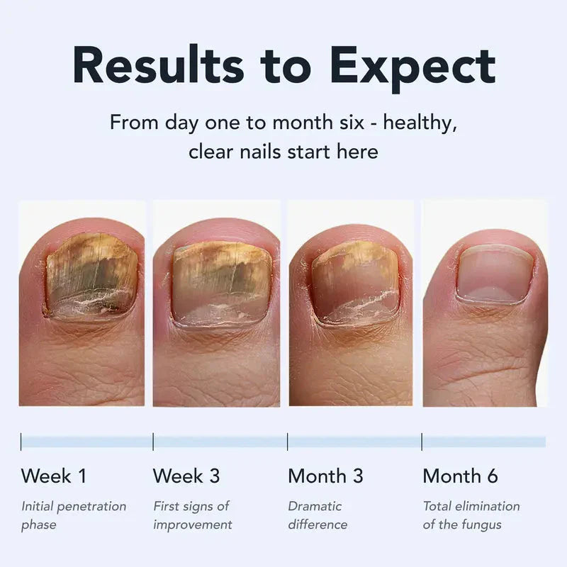 Toenail Fungus Pen - UNDECYLENIC ACID 25% - Daily Solution for Brittle & Thickened Nails