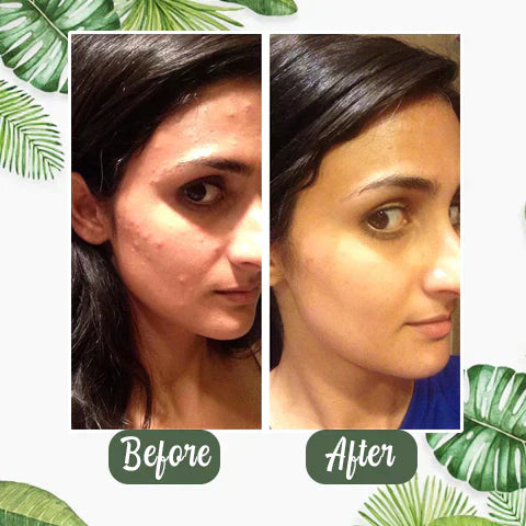 ⏰ Last 3 Hours! 🔥 Green Tea Deep Cleanse Mask – 70% OFF!