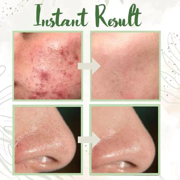 ⏰ Last 3 Hours! 🔥 Green Tea Deep Cleanse Mask – 70% OFF!